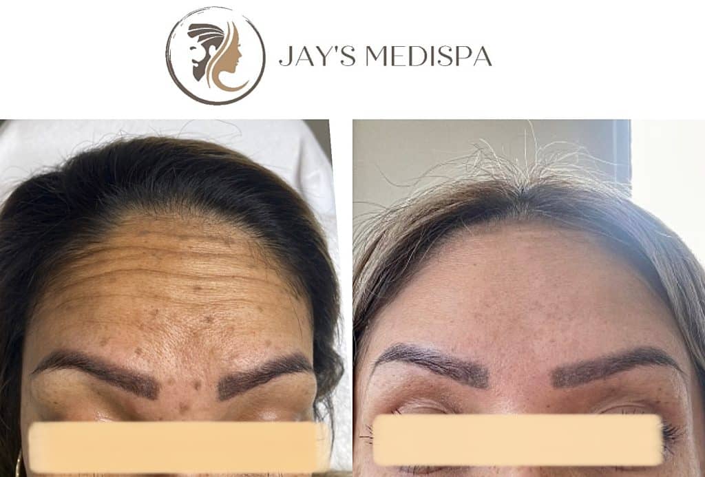 Before & After beauty treatment botox, antiwrinkle treatment