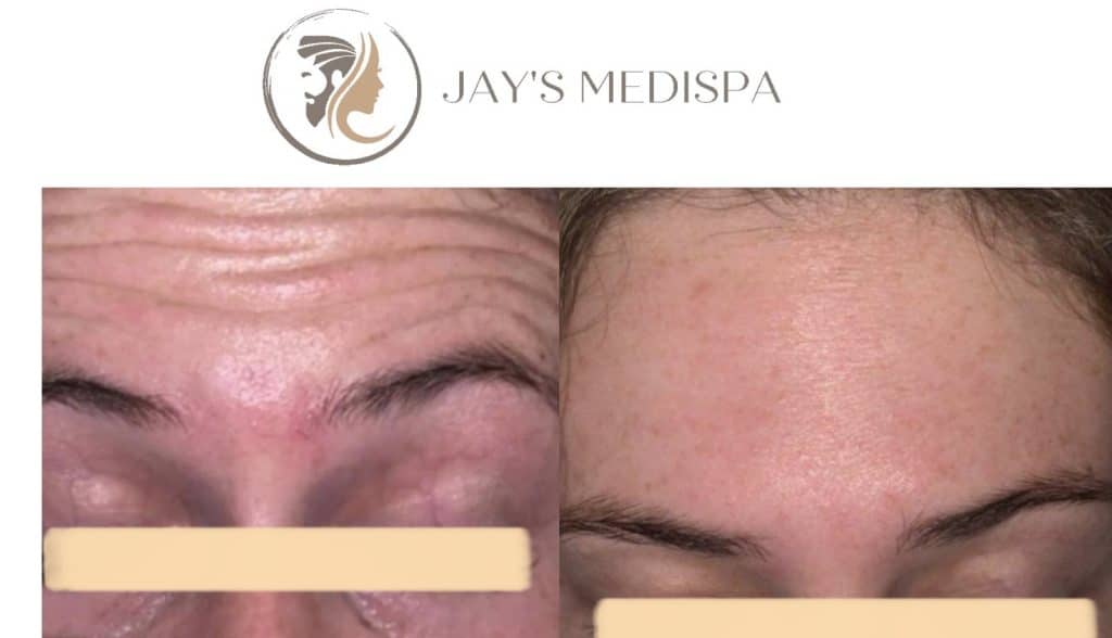 Before & After beauty treatment botox, antiwrinkle treatment