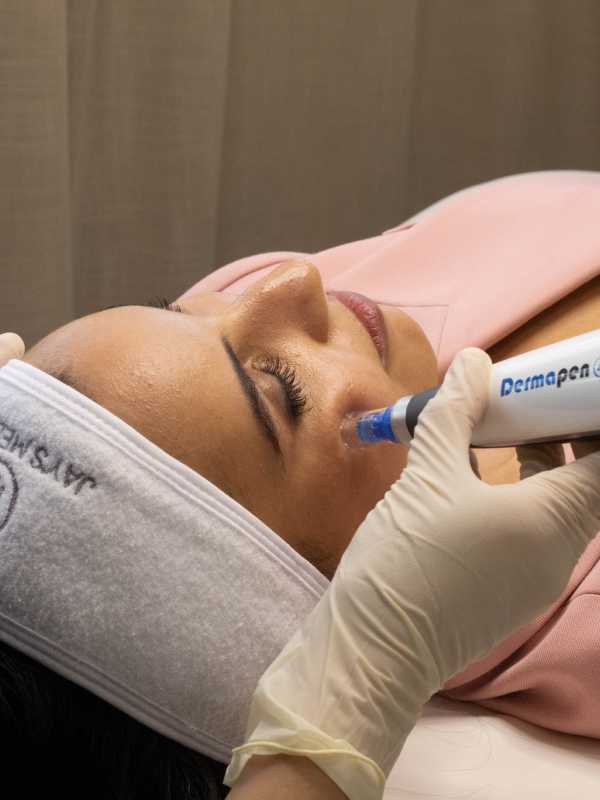 service image of microneedling