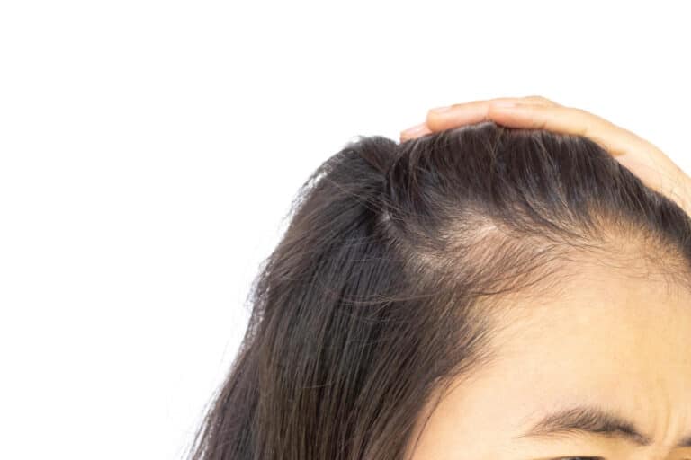 hair loss