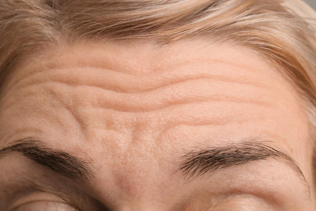 wrinkle treatments